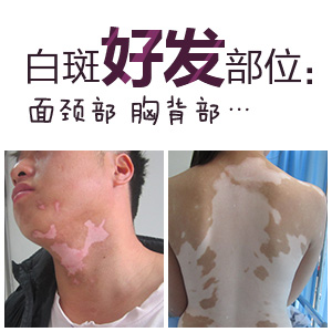 治白癜风成都哪个医院好