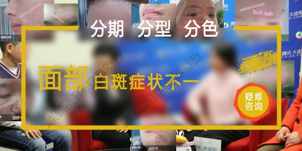治白癜风成都哪个医院好