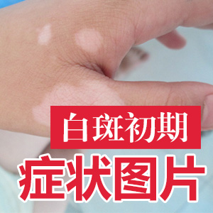 治白癜风成都哪个医院好